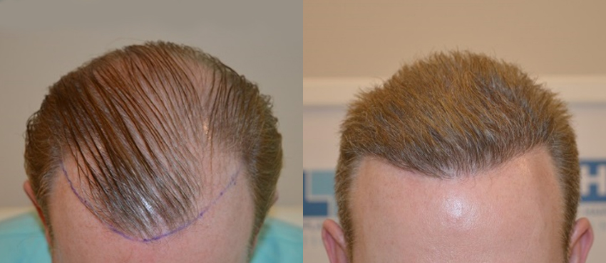 results of hair transplant in dhi delhi clinic