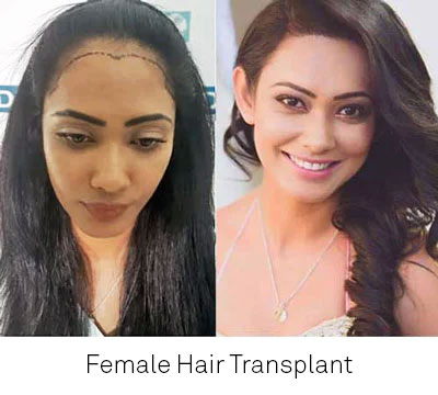 Female Hair Transplant in India