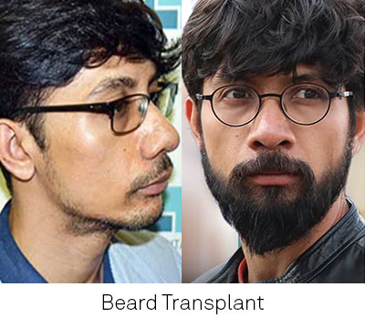 Beard Transplant in India