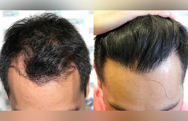 before and after hair transplant photo 1