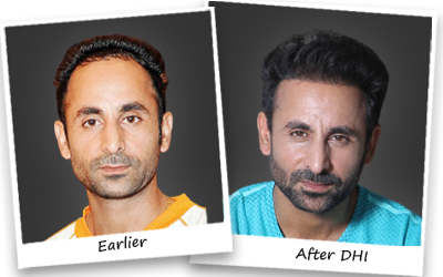 Prabhjot singh hair transplant