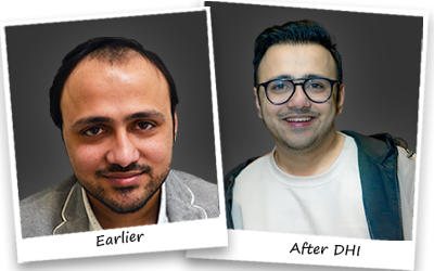 Shaad Rahman hair transplant