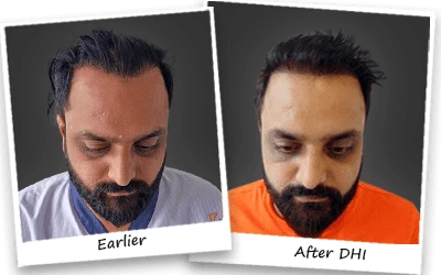 sandeep sharma hair transplant