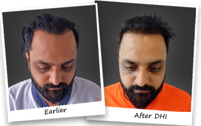 sandeep sharma hair transplant