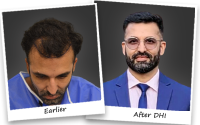 shail hair transplant