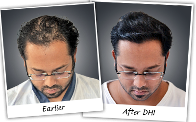 Avhishek hair transplant
