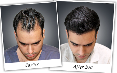 DHRUV-DHAMIJA hair transplant