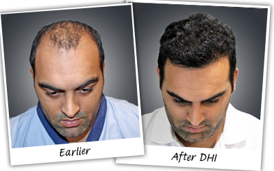 Kunal hair transplant