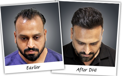 GAURAV-GARG hair transplant