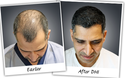 Himanshu hair transplant