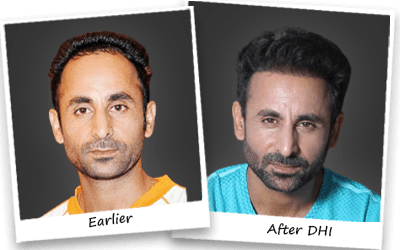 Prabhjot singh hair transplant