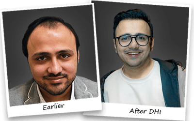 best hair transplant in delhi