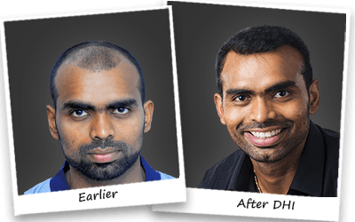 Parattu Raveendran Sreejesh hair transplant