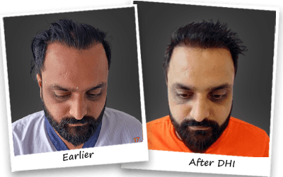 sandeep sharma hair transplant