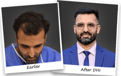 shail hair transplant