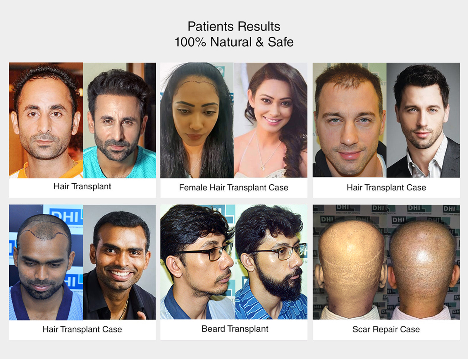 dhi Patient reasult - natural and safe
                     