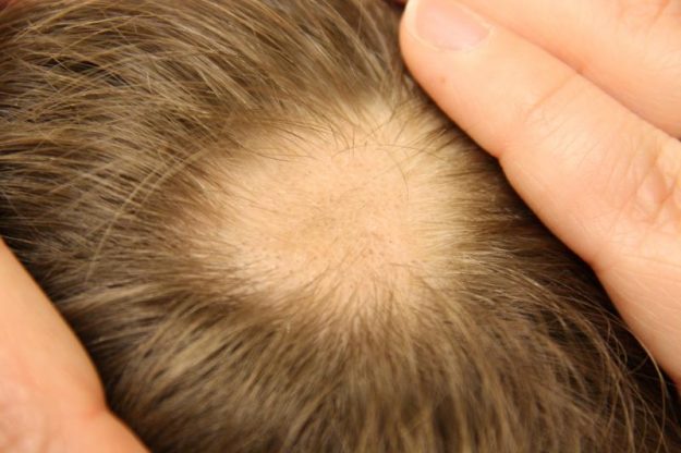 Types of Alopecia Types of Alopecia