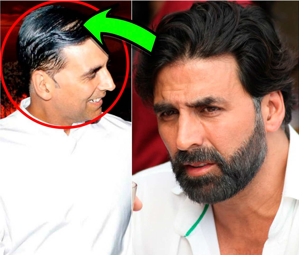 Everything you want to know about hair transplants from Bollywoods  favourite hair surgeon  Times of India