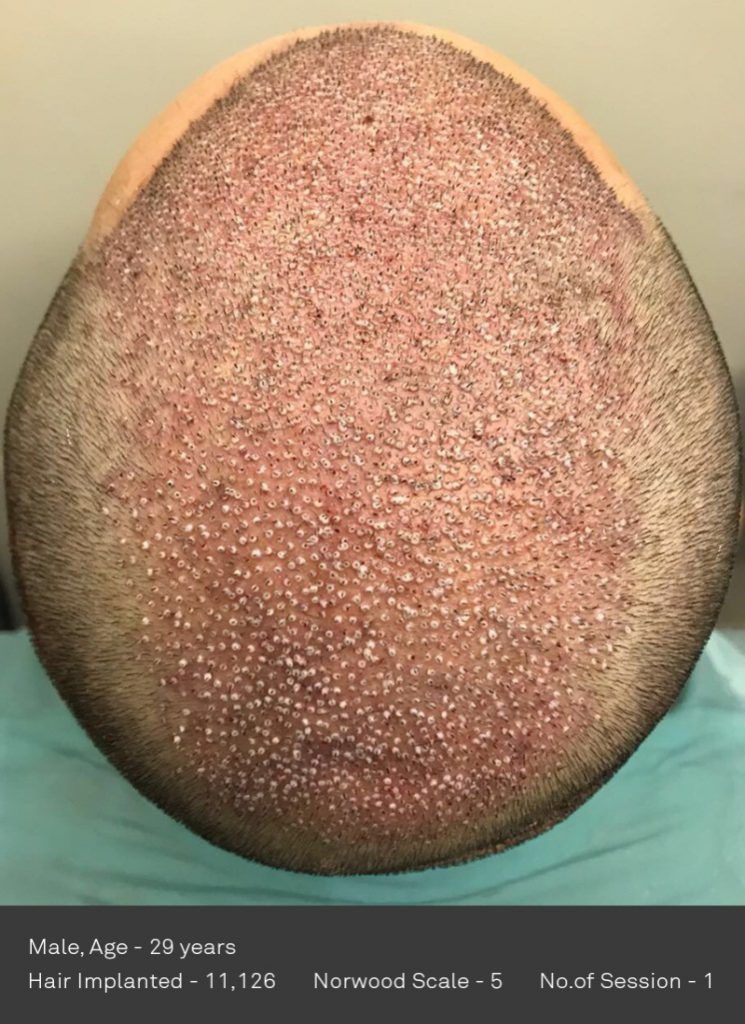 DHI International Transplants 11,126 follicles in a single session (!), the highest in the history of Hair Transplants!