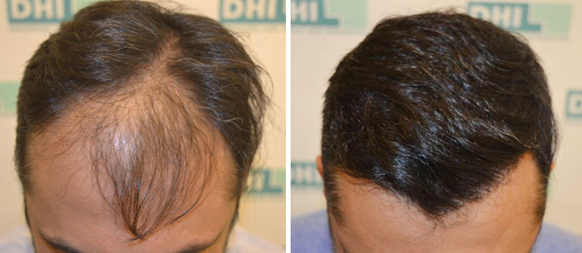 hair transplant blog - pic 7