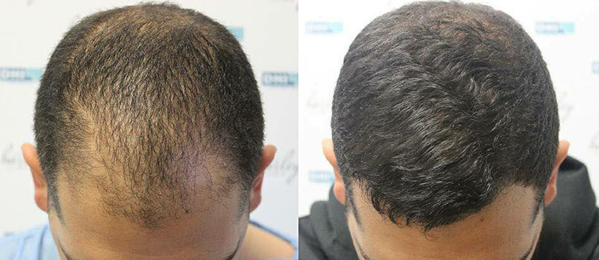 hair transplant blog 