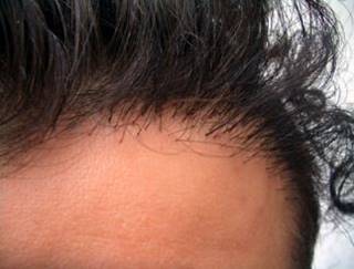 Best Hair Transplant Clinic in Kochi Cochin Kerala  Almeka Clinic Kochi