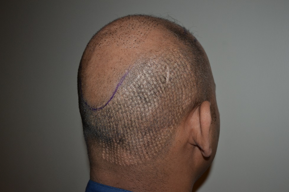 Hair Loss Solution The FUE Procedure  Advanced Hair Restoration