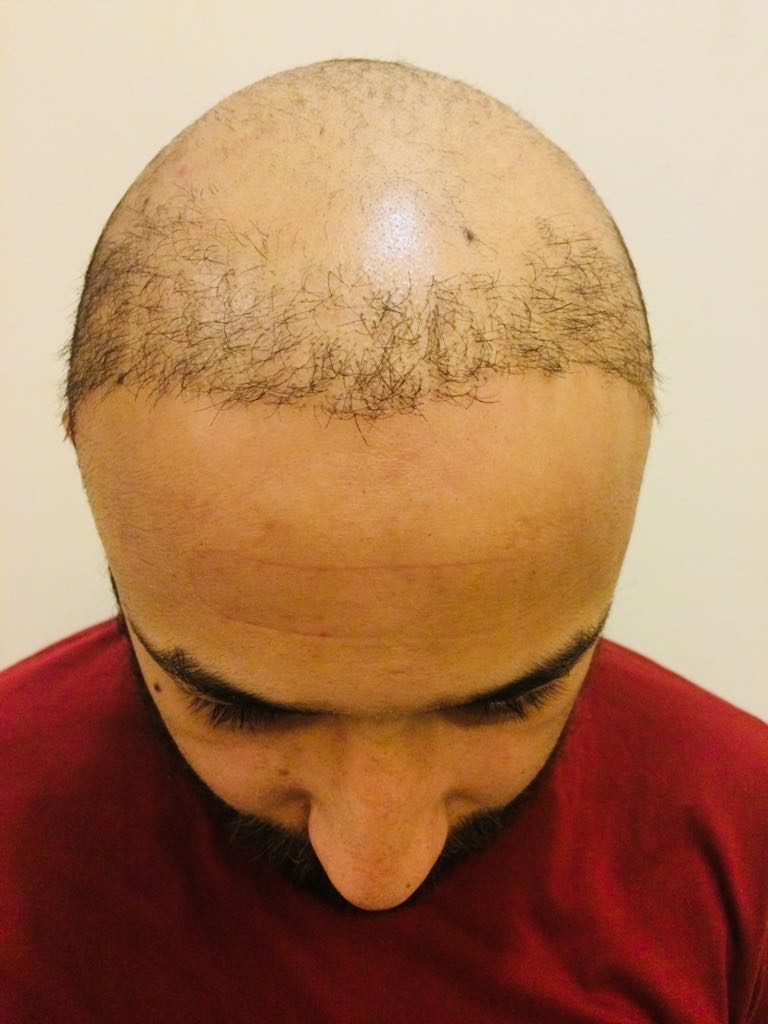 The Best Place to Get a Hair Transplant in India - DHI International