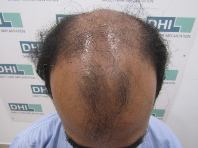 7000 Hairs in 7 hrs only - New Benchmarks in Hair Transplant