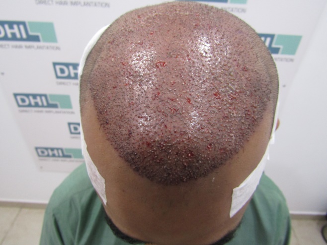 Photos after hair implantation