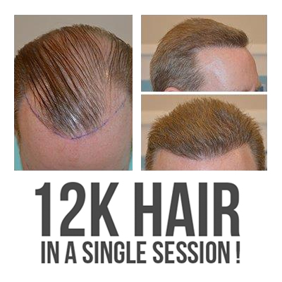 12,000 plus follicles implanted for a complete transformation, in just 11 hours!
