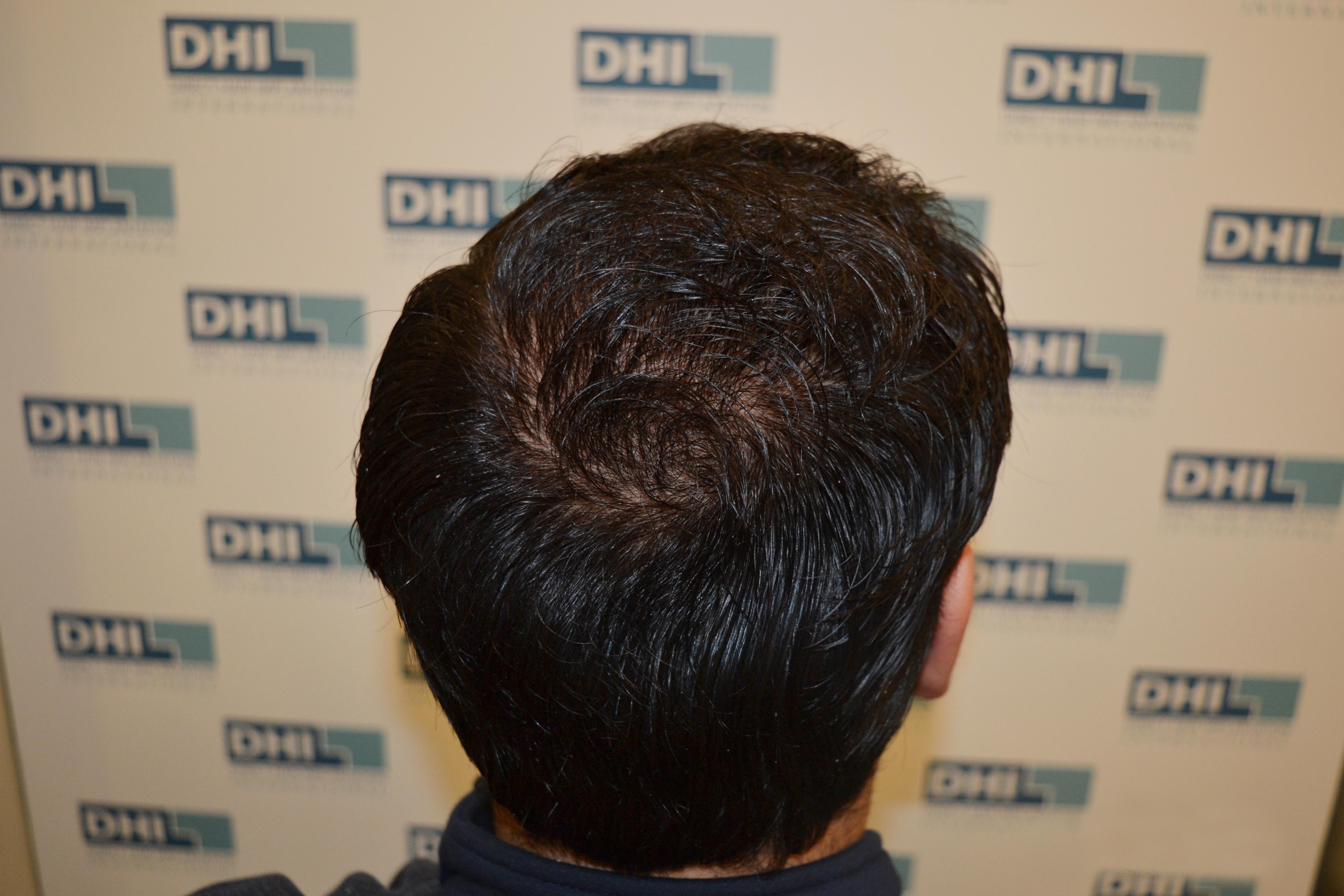 hair transplant results