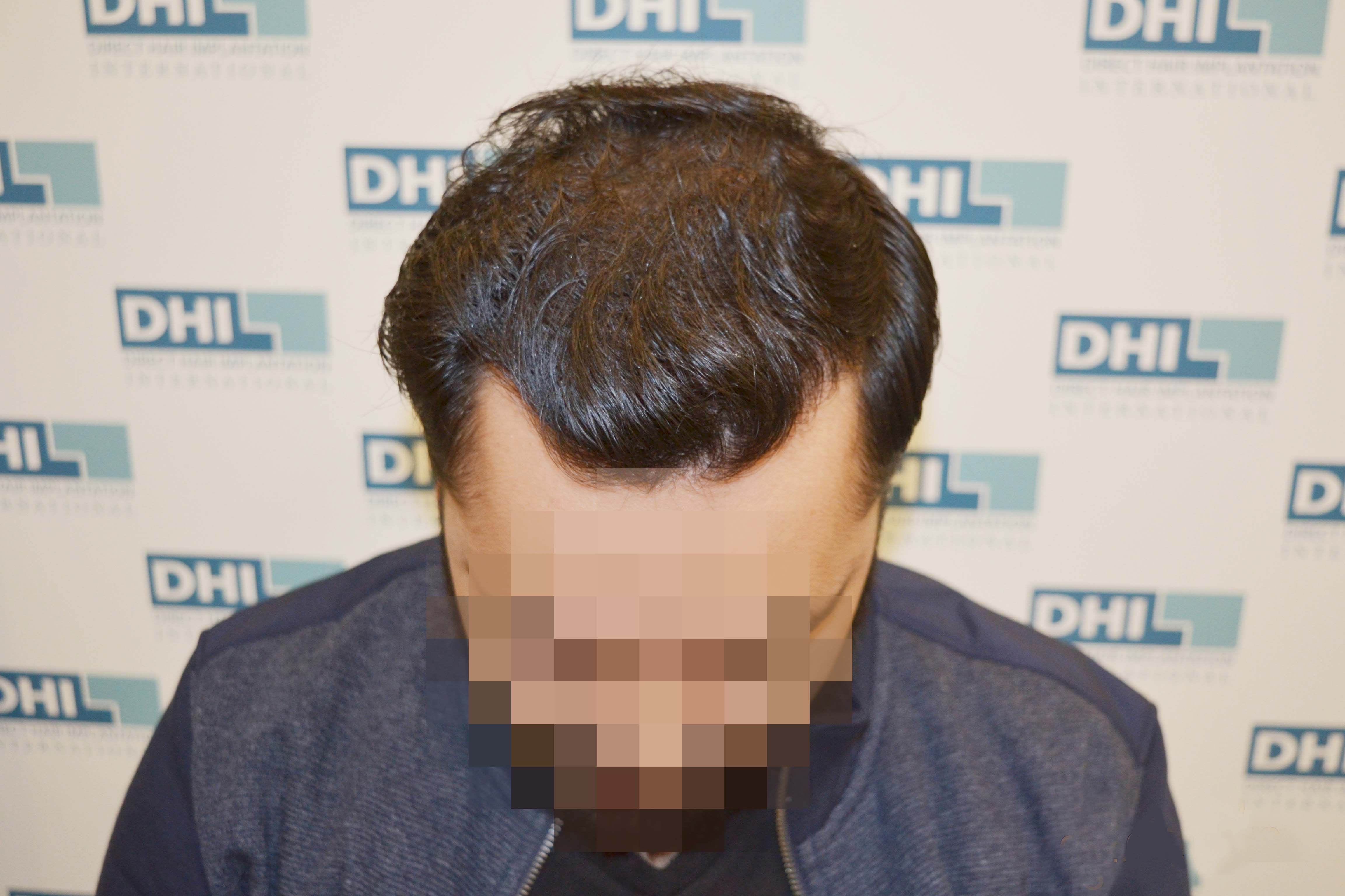 hair transplant results