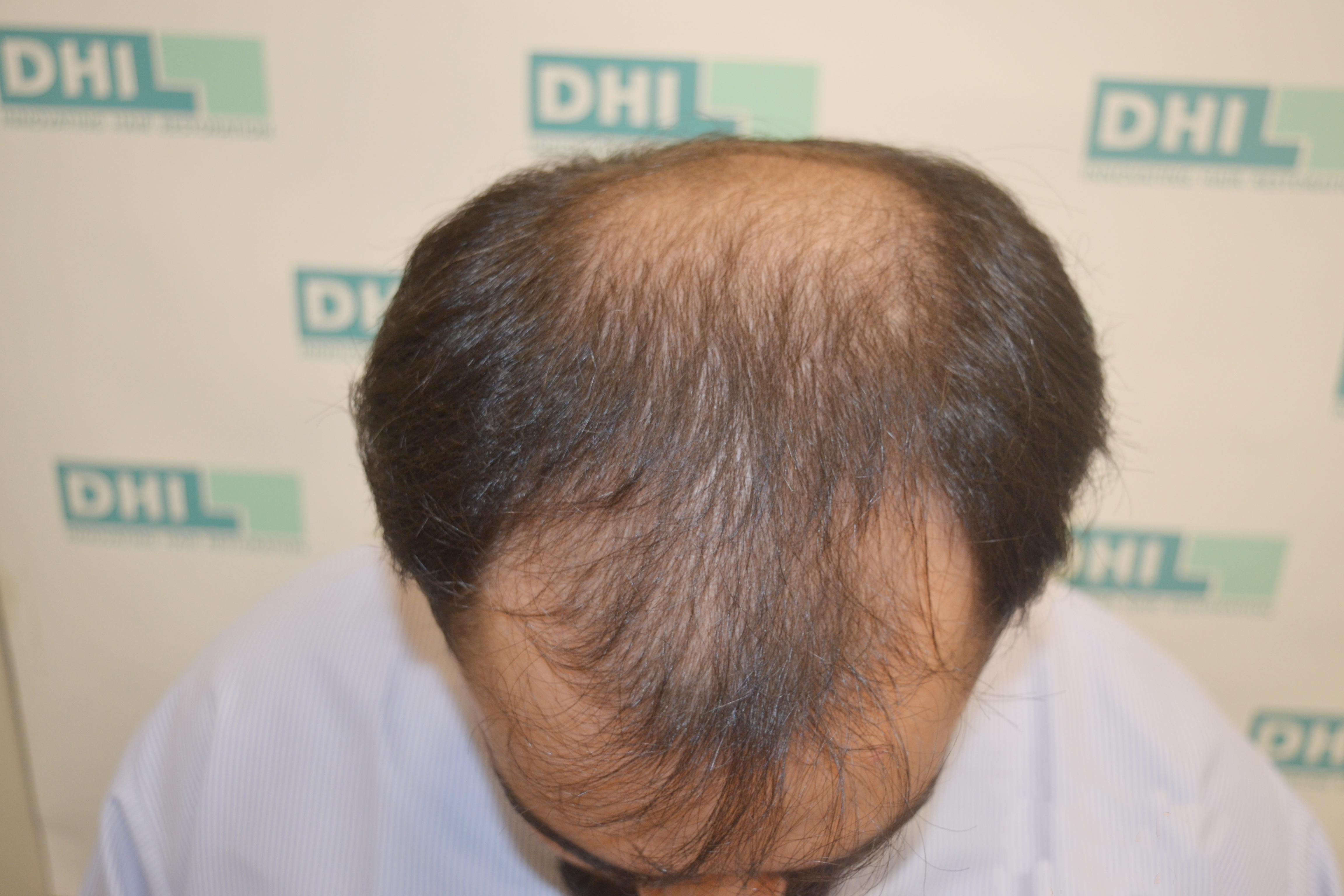 hair transplant procedure