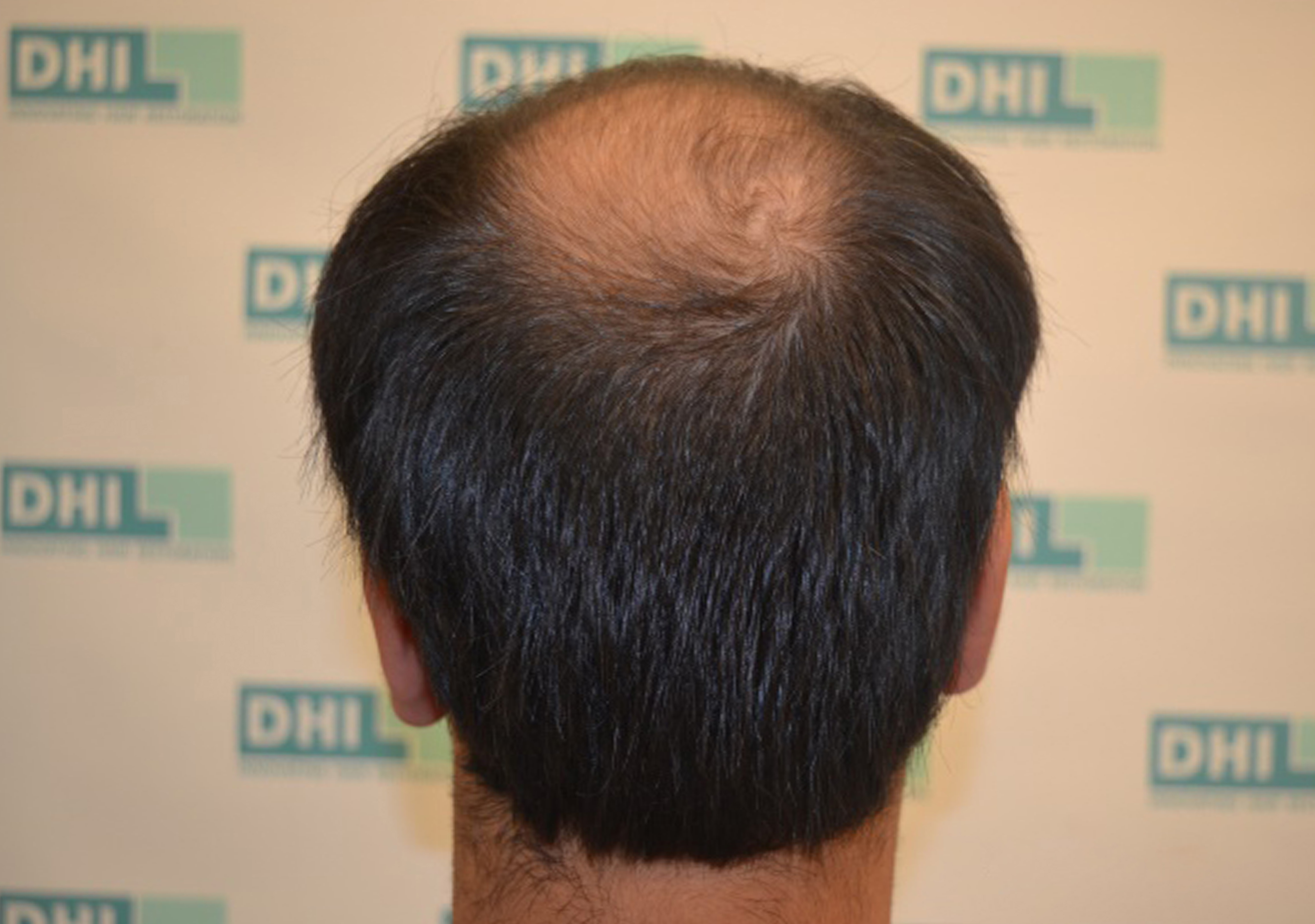 hair transplant procedure