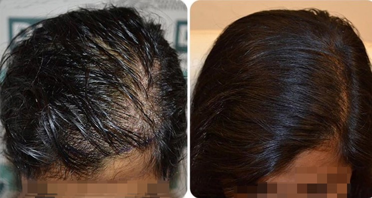 Hair Loss  Best Skin and Hair Clinic In Chennai  Render Clinic