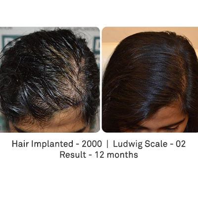 Terrific results from a complex female hair transplant case - DHI