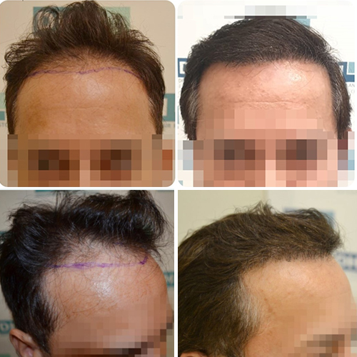 hair transplant results- DHI