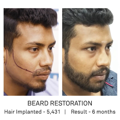 Beard Transplant & Restoration Case - DHI Direct Technique Beard Transplant