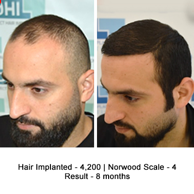 Hair Transplant Cost in India Current Price Details  IBH