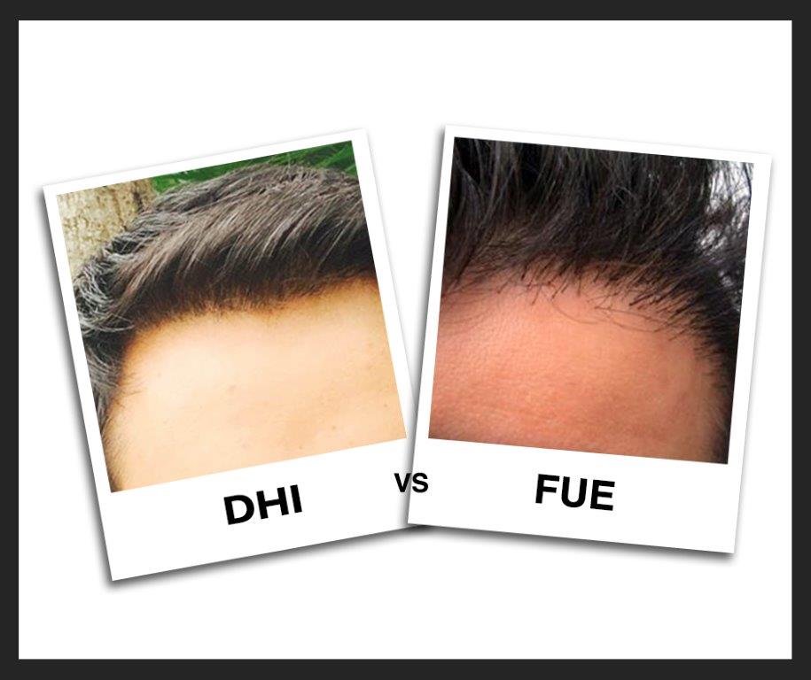 DHI vs FUE - difference between dhi and fue