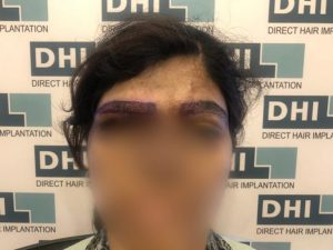 Eyebrow transplant for acid burnt victim dHI