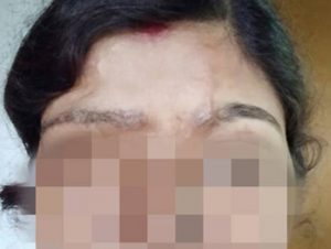 Eyebrow transplant for acid burnt victim dHI