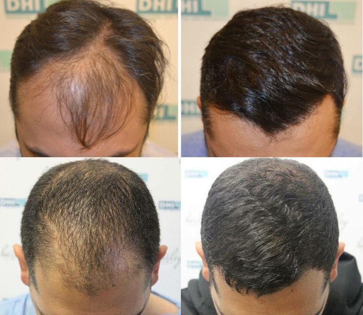 How Much Does Hair Transplant Cost? - DHI International