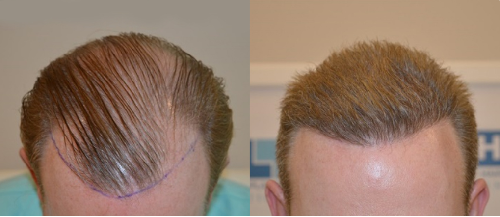Dhi пересадка волос. Трансплантация волос DHI методом. Метод пересадки волос DHI. Пересадка волос методом fue.