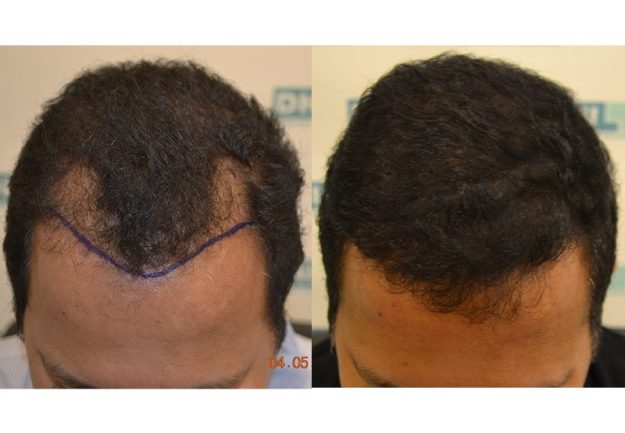 Ajay_Sir mr ajay hair transplant