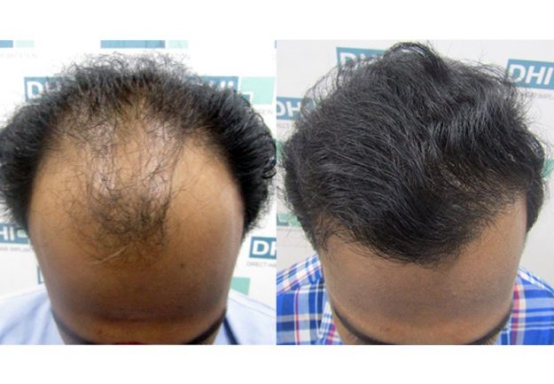 Patient_before_after hair transplant before and after pic at DHI