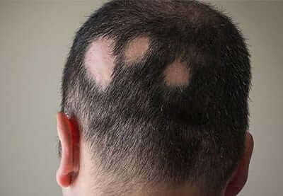 alopecia areata example