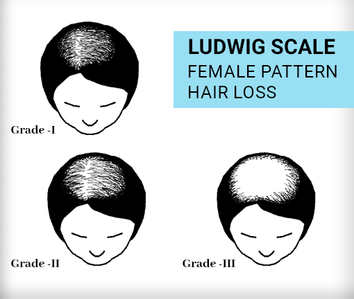 Ludwig's Scale for Women - Use Ludwigs Scale Chart For Hair Loss