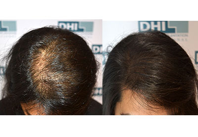 Does Alopecia Areata cause hair thinning? - Dr Batra's®